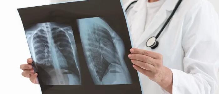 โรคร้ายแรงมีอะไรบ้าง โรคปอดอักเสบ ปอดบวม